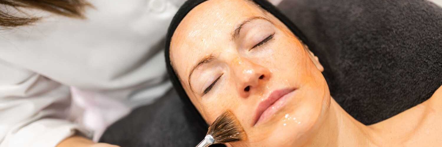 Chemical Peel for Acne Scars