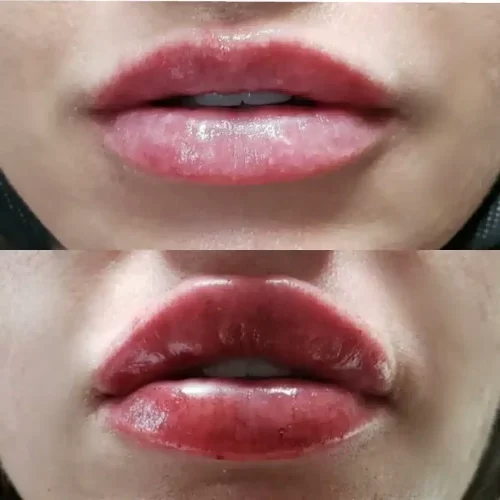 Lip injections before & after 1