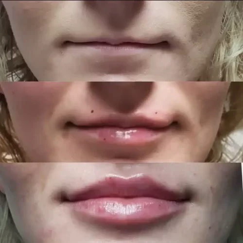 Lip injections before & after 2